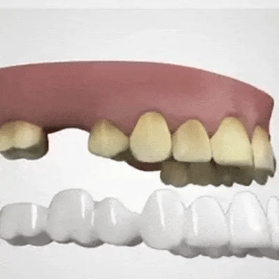 Denwhite®: Carillas Dentales Ajustables - Set 2 Pzs (Superior e inferior)