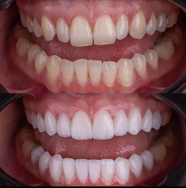 Denwhite®: Carillas Dentales Ajustables - Set 2 Pzs (Superior e inferior)
